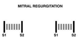 Mitral regurgitation