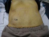 obese abdomen