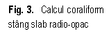 Text Box: . 3.  Calcul coraliform stang slab radio-opac