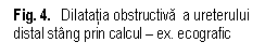 Text Box: . 4.   Dilatatia obstructiva  a ureterului 
distal stang prin calcul  ex. ecografic
              
