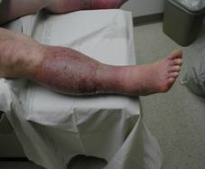 venous insufficiency