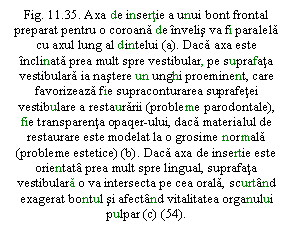 Text Box: . 11.35. Axa de insertie a unui bont frontal preparat pentru o coroana de invelis va fi paralela cu axul lung al dintelui (a). Daca axa este inclinata prea mult spre vestibular, pe suprafata vestibulara ia nastere un unghi proeminent, care favorizeaza fie supraconturarea suprafetei vestibulare a restaurarii (probleme parodontale), fie transparenta opaqer-ului, daca materialul de restaurare este modelat la o grosime normala (probleme estetice) (b). Daca axa de insertie este orientata prea mult spre lingual, suprafata vestibulara o va intersecta pe cea orala, scurtand exagerat bontul si afectand vitalitatea organului pulpar (c) (54).


